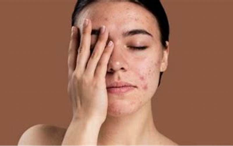 Cara Menghilangkan Jerawat Pasir Dengan Skincare Yang Tepat