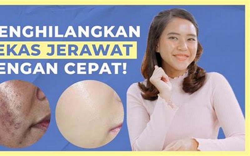 Cara Menghilangkan Jerawat Yang Menghitam