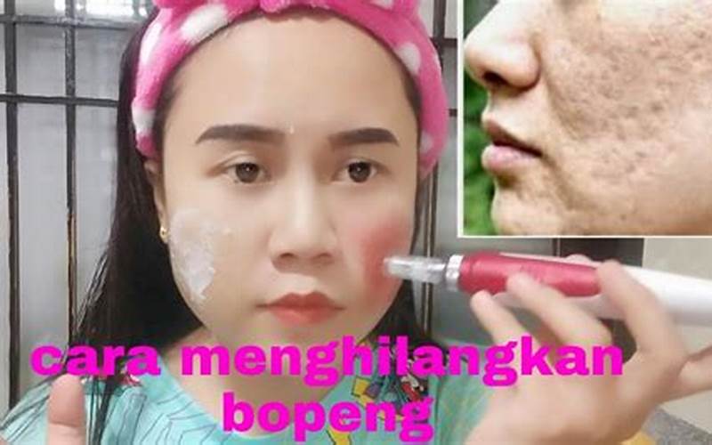 Cara Menghilangkan Scar Bekas Jerawat