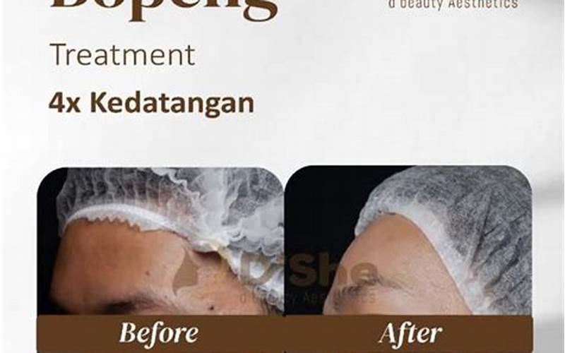 Cara Menyembuhkan Pori Besar Dan Bekas Jerawat Dengan Serum