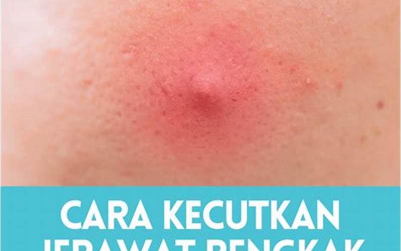 Cara Meredakan Jerawat Bengkak