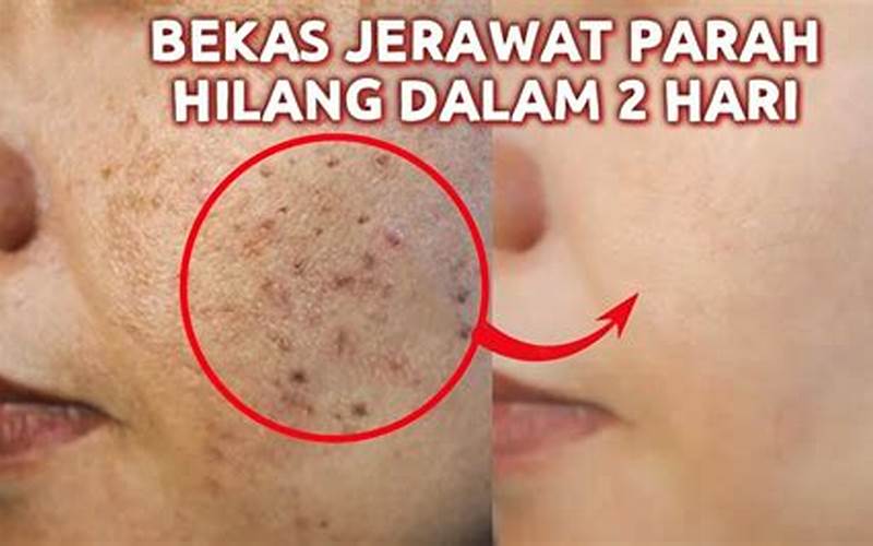 Cara Permanen Menghilangkan Bekas Jerawat Merah Di Wajah