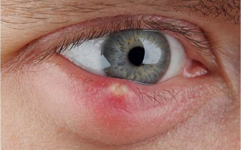 Chalazion