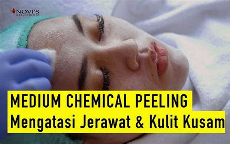 Chemical Peeling Untuk Jerawat