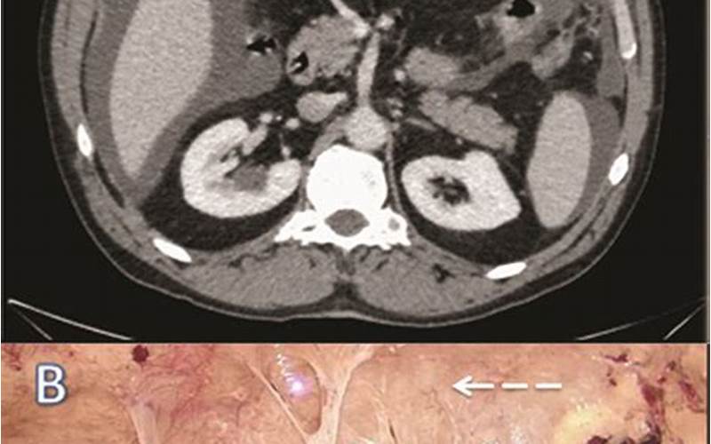 Ct Scan Of Peritoneal Mesothelioma