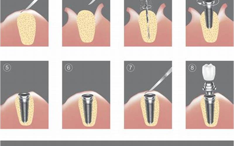 Dental Implants Uncovering