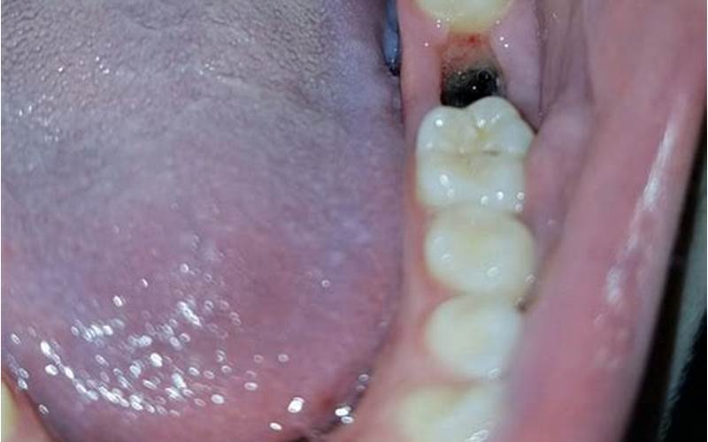 Gum Healing After Wisdom Teeth Removal