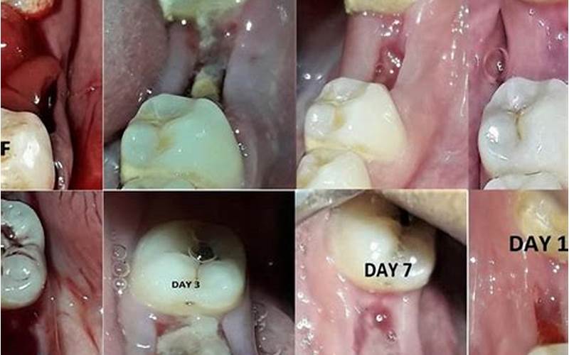 Healing Gums After Wisdom Teeth Removal