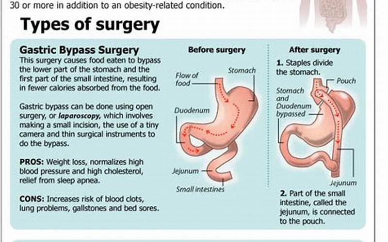 Interested In Weight Loss Surgery