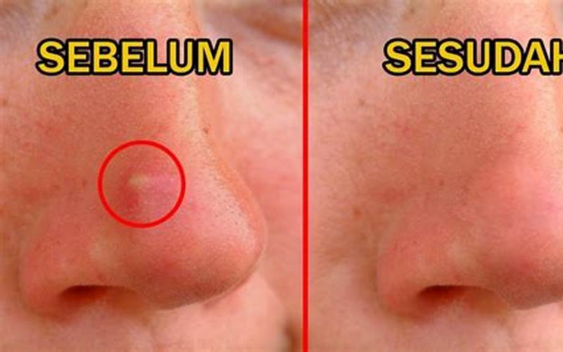 Jerawat Ditengah Hidung: Apa Penyebabnya Dan Bagaimana Cara Mengatasinya?