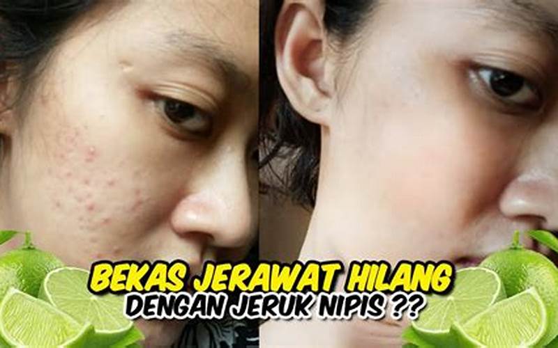 Jeruk Nipis Bekas Jerawat: Cara Mengobati Jerawat Dengan Jeruk Nipis