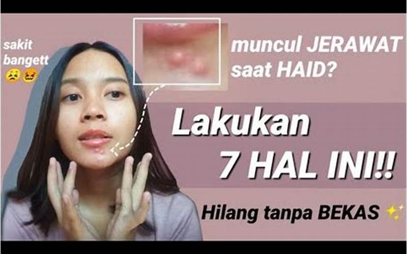 Kenapa Saat Menstruasi Keluar Jerawat?