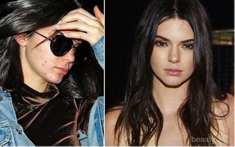 Kendall Jenner Jerawat: Bagaimana Dia Menghilangkan Jerawatnya?