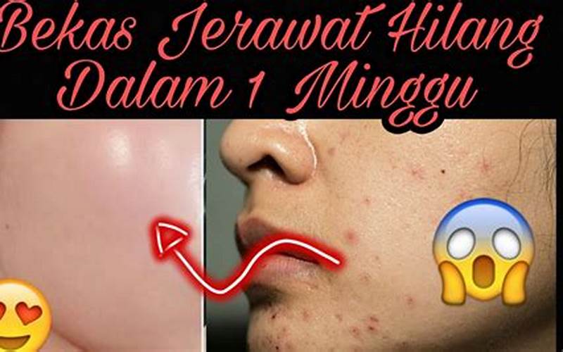 Masker Penghilang Jerawat Dan Bekas Jerawat