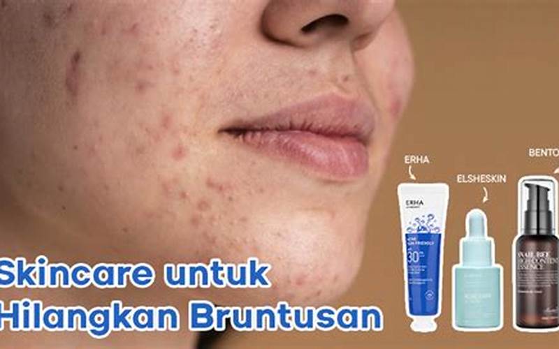 Memilih Skincare Terbaik Untuk Jerawat Bruntusan