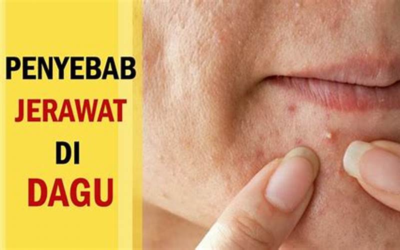 Mengatasi Jerawat Di Bawah Mulut