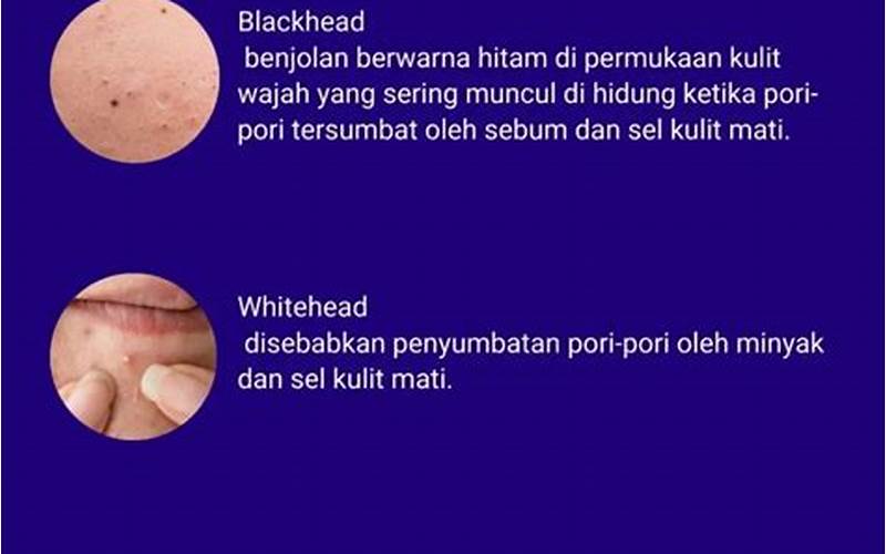 Mengenali Jerawat Mateng Dan Cara Mengatasinya