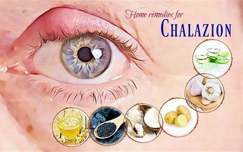 Natural Remedies For Chalazion