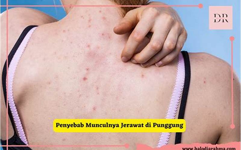 Penyakit Jerawat Di Punggung: Apa Yang Harus Dilakukan?