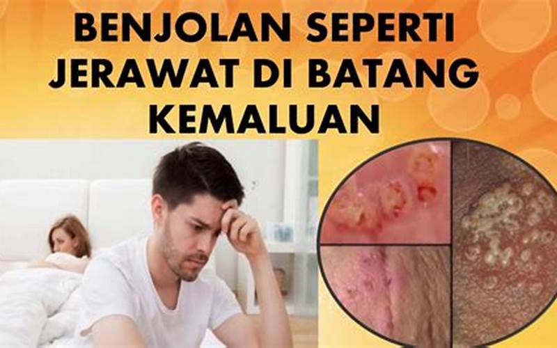 Penyakit Kelamin Wanita Seperti Jerawat