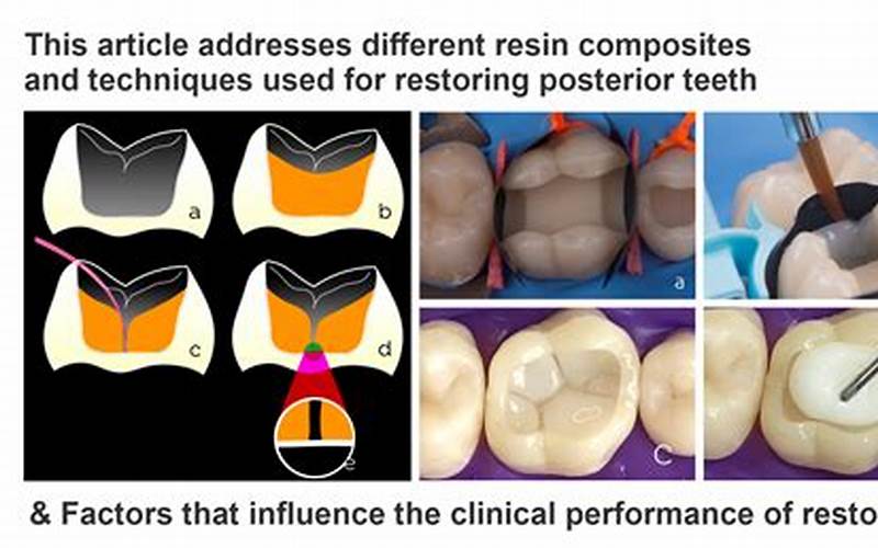 Placement Of Resin Composite 1S Posterior