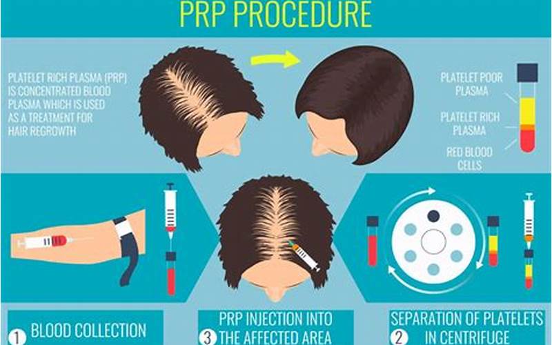 Prp Therapy Procedure