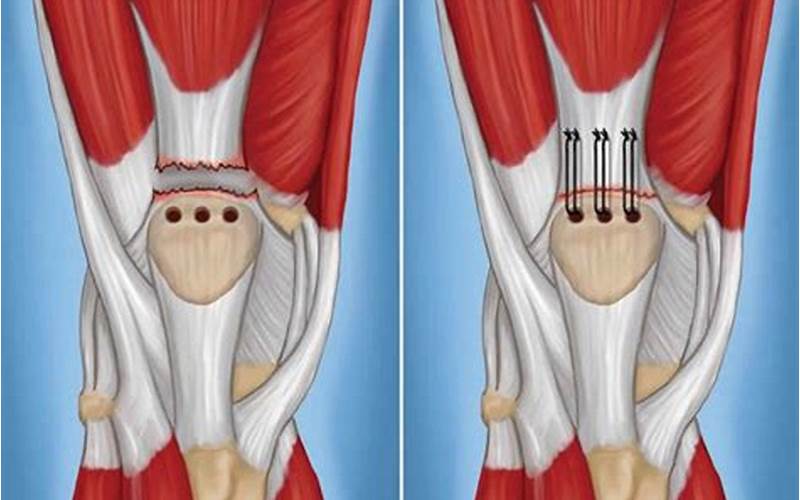 Ruptured Quadriceps Tendon Stories: Causes, Symptoms, and Treatments