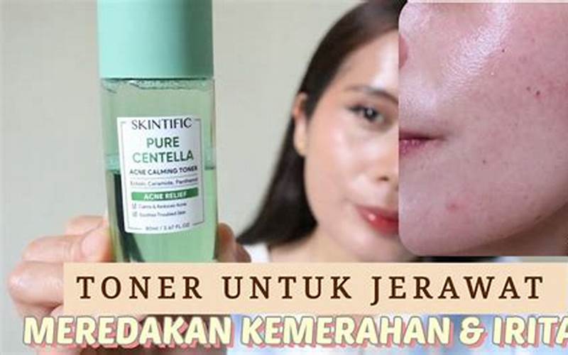 Review Toner Jerawat - Kenali Kandungan Dan Manfaatnya