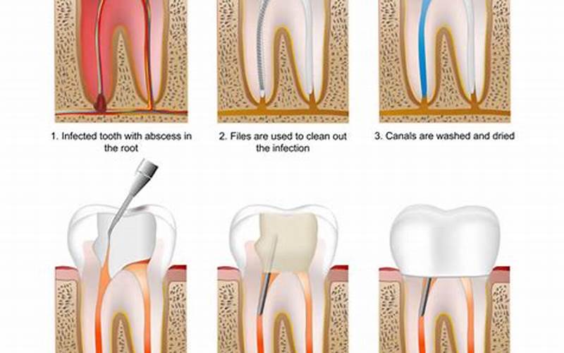 Does Aspen Dental Do Root Canals?