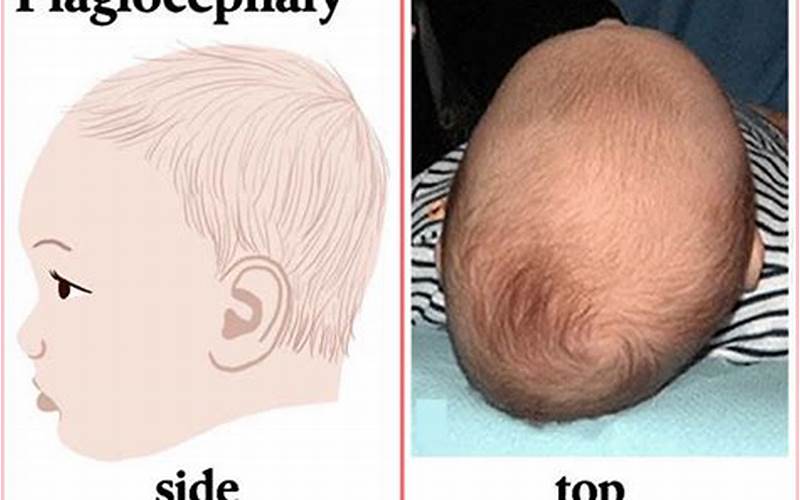 Symptoms Of Plagiocephaly In Adults