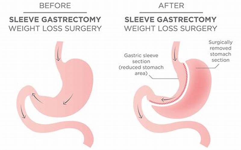 Tips For Improving Intimacy After Gastric Sleeve Surgery