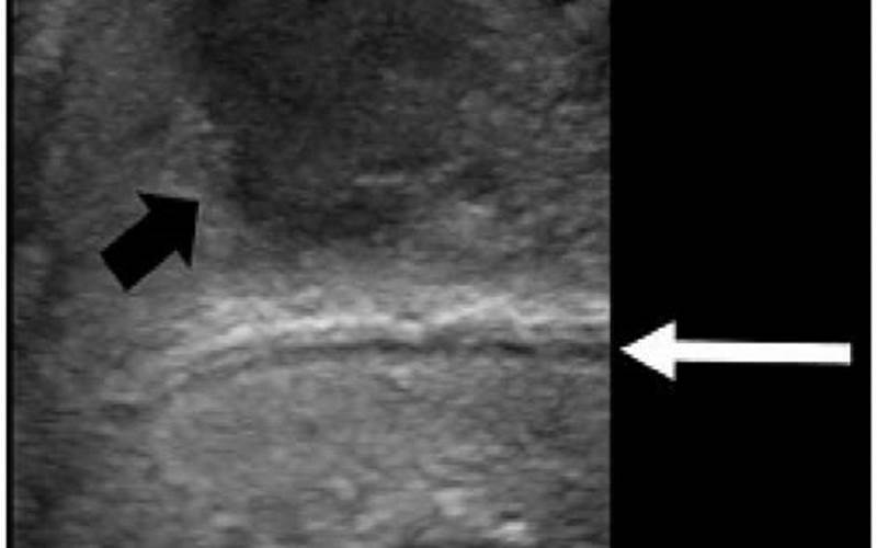 Treatment Options For Dorsal Vein Rupture