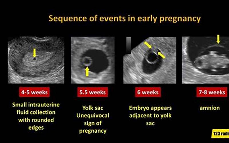 What Can You Do If You Have An Empty Sac At 8 Weeks