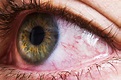 Bloodshot Eyes: 20 Reasons Why Eyes Are Red