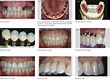 Biologically Oriented Preparation Technique (b.o.p.t.) On Teeth And ...