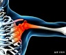 中医对于治疗肩周炎有哪些方法？ - 知乎