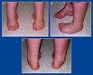 CAVUS - FOOT AND ANKLE DEFORMITIES - Principles and Management of ...