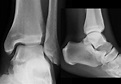 Radiograph showing chip fractures at the articular side of the medial ...