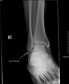 ankle x-ray | fibula chip fracture(s) and low ankle sprain | Mike Matz ...