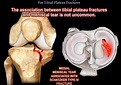 Extensile Approach for Tibial Plateau Fractures — OrthopaedicPrinciples.com