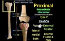 Tibial Plateau Fractures — OrthopaedicPrinciples.com