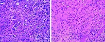 Descripción microscópica de adenocarcinoma gástrico difuso. Izquierda ...