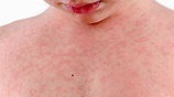 Rash on Chest Pictures, Causes, Symptoms, Remedies and Treatment ...