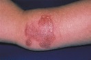 Skin Ulcers Associated With a Tender and Swollen Arm | Dermatology ...