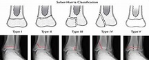 Ankle Fracture | Boston Medical Center