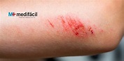 Heridas más comunes en la piel – Medifácil