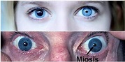 Miosis – Constricción de la Pupila: Causas, Síntomas y Tratamiento ...