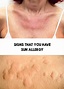 Sun allergy - Signs that you have sun allergy | Sun allergy, Allergies ...