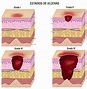 Staging Of Pressure Ulcers Bed Sores - Gambaran