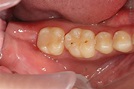 智齒與蛀牙 | 雅術牙醫診所
